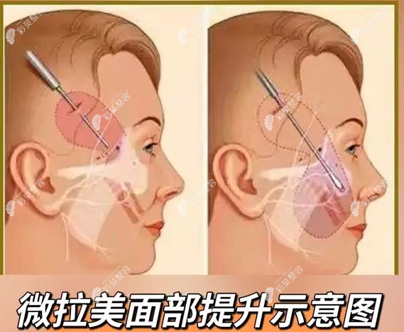 微拉美面部提升示意圖 微拉美面部提升示意圖