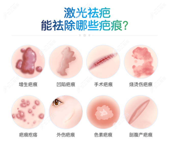 燒傷后的新疤痕多久做激光好,激光能淡化到幾乎看不見嗎？