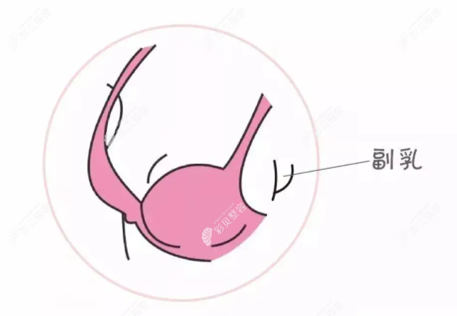 副乳切除是小手術(shù)嗎 副乳切除是小手術(shù)嗎