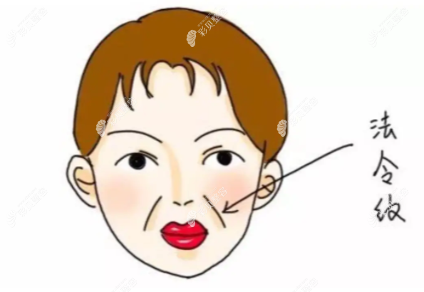 法令紋有哪些方法去除,玻尿酸/熱瑪吉/脂肪填充/拉皮術(shù)等