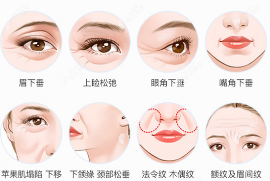 脂肪填充去除法令紋能維持多久 脂肪填充去除法令紋能維持多久