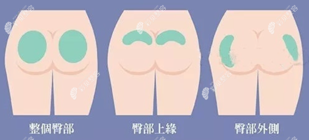 國(guó)內(nèi)假體豐臀醫(yī)院哪家好?北京,深圳假體隆臀好醫(yī)院名單推薦