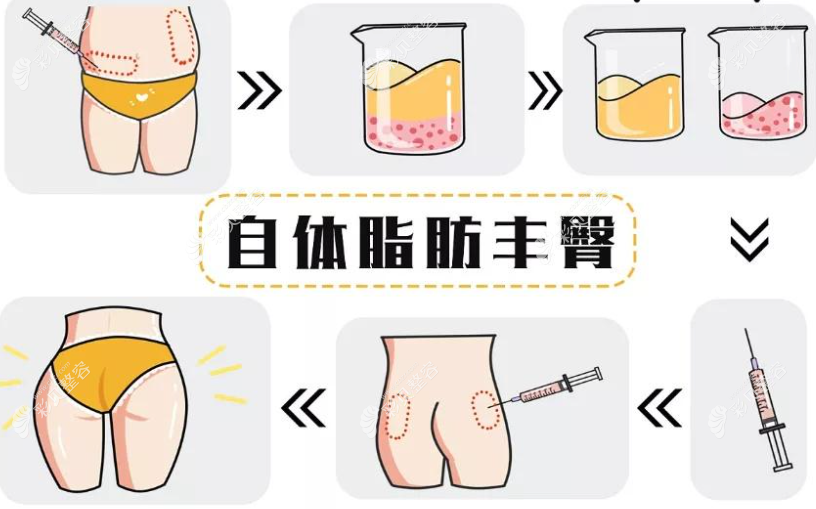 自體脂肪豐臀過程圖解 自體脂肪豐臀過程圖解