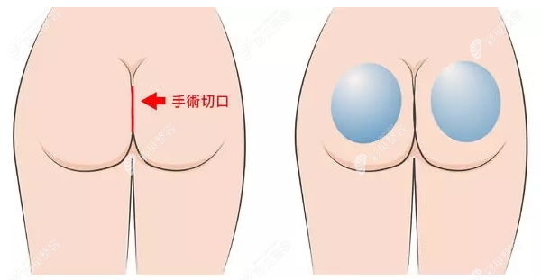北京華韓余恩旭醫(yī)生假體豐臀技術(shù)怎么樣 北京華韓余恩旭醫(yī)生假體豐臀技術(shù)怎么樣