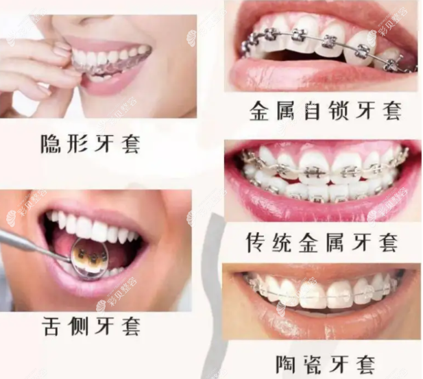 合肥華美嘉淮口腔王巖醫(yī)生做牙齒矯正怎么樣