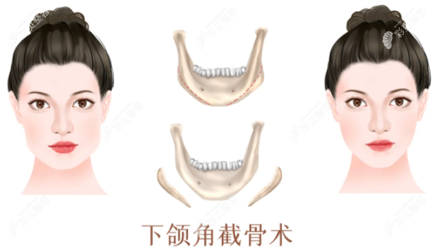 廣州韓妃整形醫(yī)院柳超醫(yī)生磨骨手術(shù)怎么預約掛號