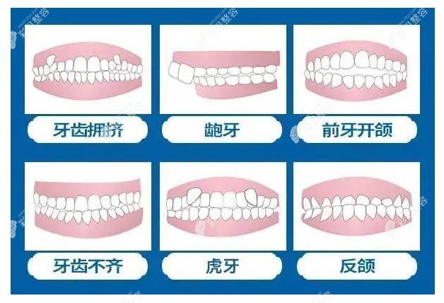 胥楊醫(yī)生做牙齒矯正怎么樣 胥楊醫(yī)生做牙齒矯正怎么樣