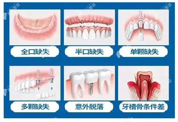 鄒祥飛醫(yī)生做種植牙怎么樣 彩貝網(wǎng) 鄒祥飛醫(yī)生做種植牙怎么樣 彩貝網(wǎng)